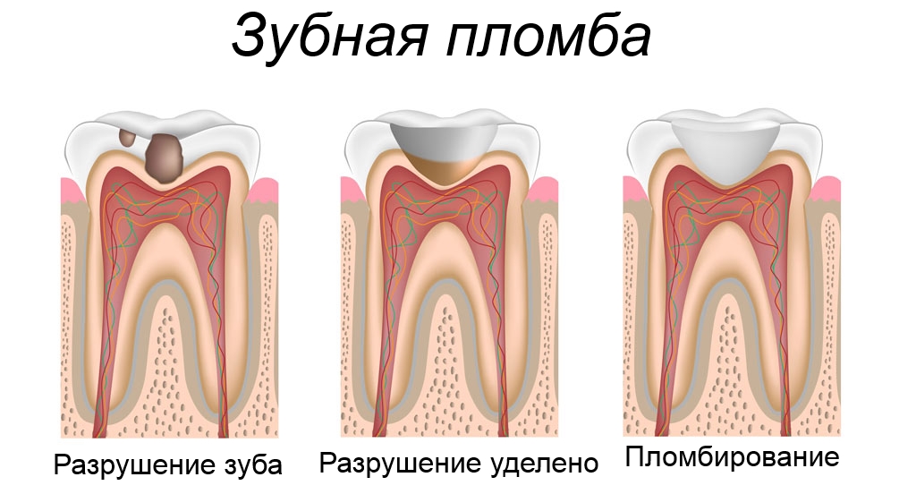 Почему болит зуб после установки пломбы 02 Почему болит зуб после установки пломбы 02