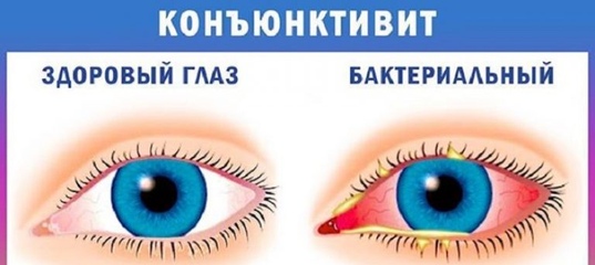Лечение конъюнктивита