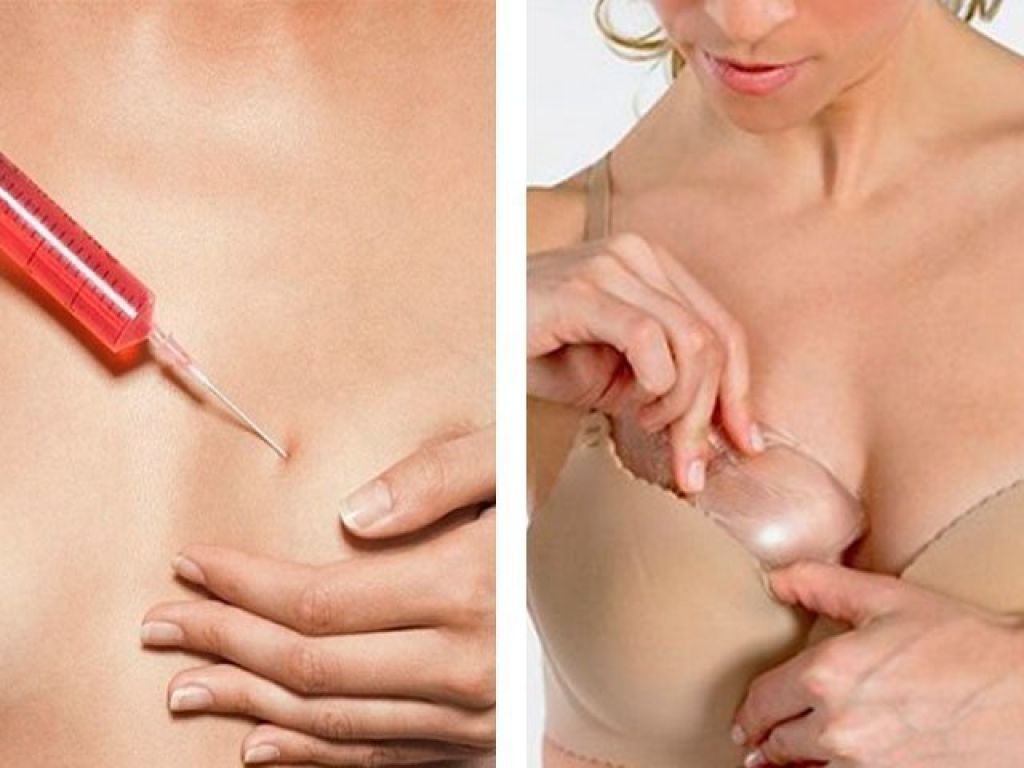 Липофилинг – способ увеличения груди без имплантов 02