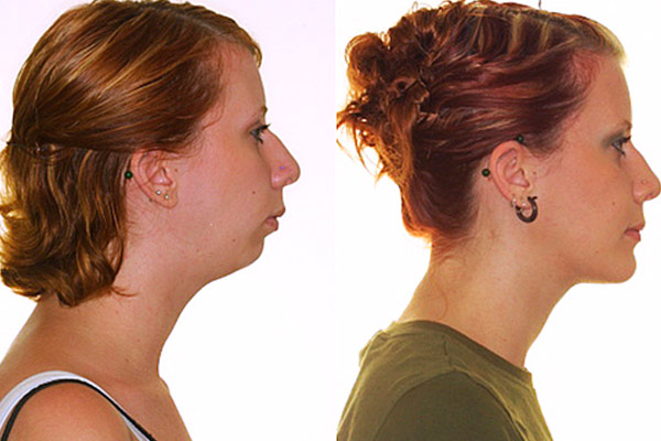 Как брекеты меняют лицо