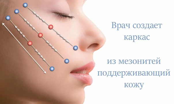 Нитевой лифтинг лица 02