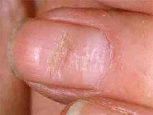 Нити мицелия лечение народными средствами. Нити мицелия лечение на ногтях