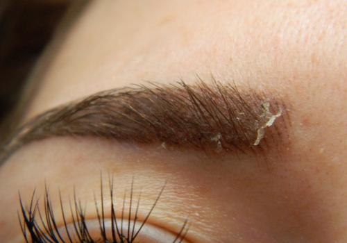 Шелушение кожи на бровях у мужчин. Причины шелушения бровей