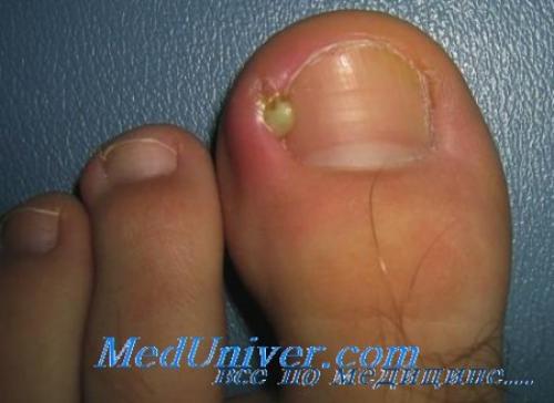 Болит палец сбоку ногтя на руке. Гной и боль в пальце возле ногтя. Как лечить нарыв около ногтя?