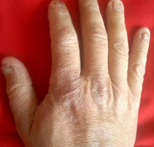 Сухая кожа рук витамины. Причины сухости кожи рук