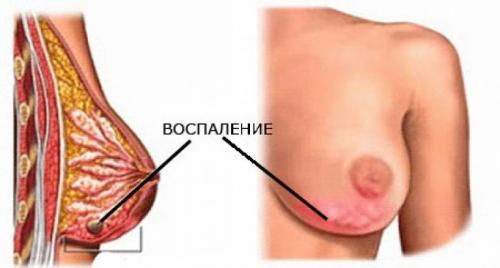 Болит левая грудь. Почему болят грудные железы - причины 16 Болит левая грудь. Почему болят грудные железы - причины 16