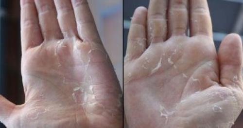 Очень сухие руки чем мазать. Причины и факторы появления на кистях и пальцах рук