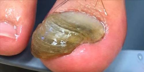 Нарывает палец на руке после пореза. Почему нарывает палец возле ногтя на руках и ногах?