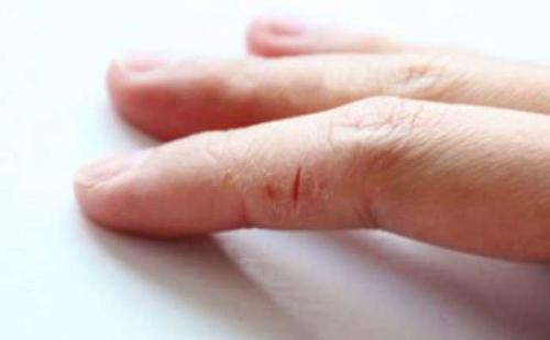 Трещины на пальцах рук лечение в домашних условиях. Питание при заживлении трещин на руках