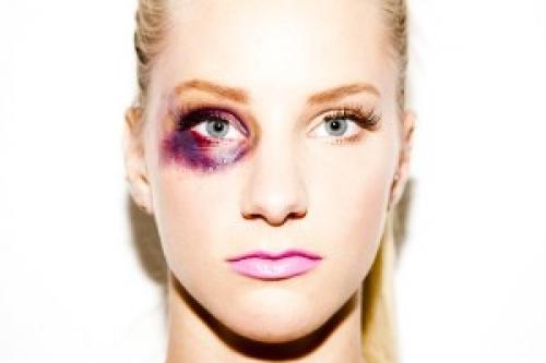 Как убрать синяк под глазом за 2 дня. Простые способы быстро избавиться от синяка 2 дневной давности под глазом