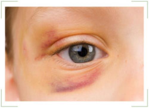 Как быстро убрать синяк под глазом от удара и опухоль. Как быстро убрать синяки?