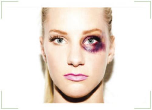 Как быстро убрать синяк под глазом от удара и опухоль. Как быстро убрать синяки?