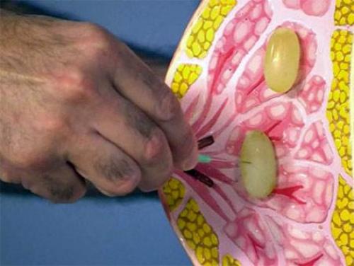 Лекарства от мастопатии молочных желез. Негормональные препараты от мастопатии 02