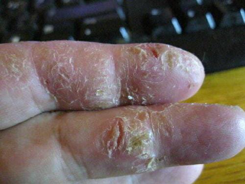 Мазь для рук от трещин сухости зуда и шелушения. Покраснение на руках и сухость кожи, трещины, шелушение, жжение зимой, зуд между пальцами. причины и лечение мазями в домашних условиях