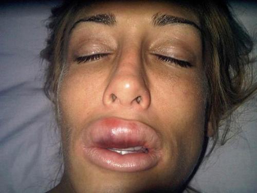 Увеличение губ противопоказания. Как влияет гиалуроновая кислота?