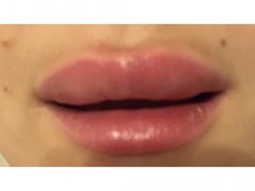 Увеличение губ подготовка к процедуре. Что представляет собой гиалуроновая кислота? 11 Увеличение губ подготовка к процедуре. Что представляет собой гиалуроновая кислота? 11