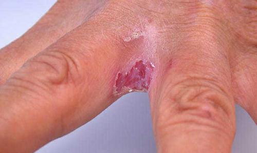 Мазь для рук от трещин сухости зуда и шелушения. Покраснение на руках и сухость кожи, трещины, шелушение, жжение зимой, зуд между пальцами. причины и лечение мазями в домашних условиях