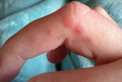 Мазь для рук от трещин сухости зуда и шелушения. Покраснение на руках и сухость кожи, трещины, шелушение, жжение зимой, зуд между пальцами. причины и лечение мазями в домашних условиях