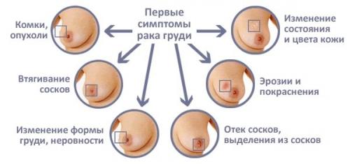 Болит грудь в области соска при нажатии. Боль при надавливании на грудь: причины и тревожные симптомы
