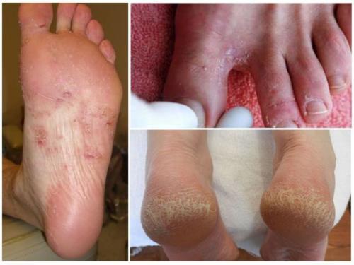 Мицелий гриба на коже, что это. Классификация по типу возбудителя