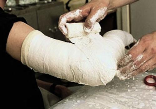 Перелом плеча повязка. Правильное наложение гипса при переломе плечевой кости при разных условиях