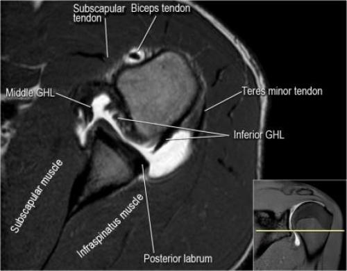 Повреждение Хилла-Сакса это. Непростой перелом головки плеча испортит не только отпуск 15 Повреждение Хилла-Сакса это. Непростой перелом головки плеча испортит не только отпуск 15