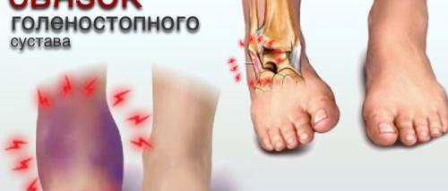 Как долго лечится растяжение связок стопы. Сколько времени заживает растяжение связок голеностопа?