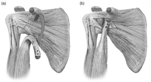 Повреждение Хилла-Сакса это. Непростой перелом головки плеча испортит не только отпуск 05 Повреждение Хилла-Сакса это. Непростой перелом головки плеча испортит не только отпуск 05