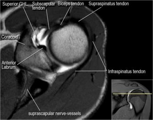 Повреждение Хилла-Сакса это. Непростой перелом головки плеча испортит не только отпуск 12 Повреждение Хилла-Сакса это. Непростой перелом головки плеча испортит не только отпуск 12