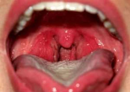 Боль в горле больше двух недель. Тонзиллит