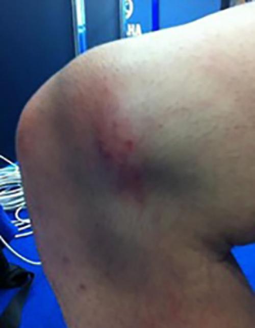 Препараты для восстановления связок колена. Уколы для восстановления связок колена