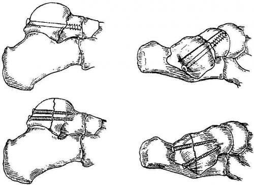 Лечение асептический некроз таранной кости. Лечение некроза таранной кости голеностопного сустава в Москве 02