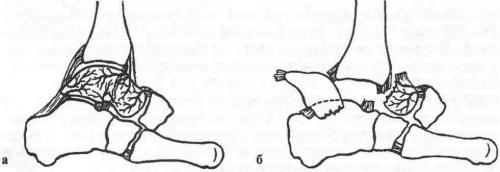 Лечение асептический некроз таранной кости. Лечение некроза таранной кости голеностопного сустава в Москве 01