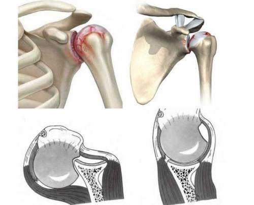 Повреждение Хилл-Сакса рентген. Что такое повреждение Хилл-Сакса