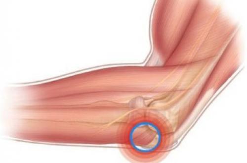 Ушиб локтевого сустава симптомы. Обзор ушиба локтевого сустава: виды, степени, симптомы и лечение 15 Ушиб локтевого сустава симптомы. Обзор ушиба локтевого сустава: виды, степени, симптомы и лечение 15