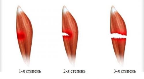 Растяжение связок икроножной мышцы лечение. Растяжение икроножной мышцы: симптомы и лечение боли