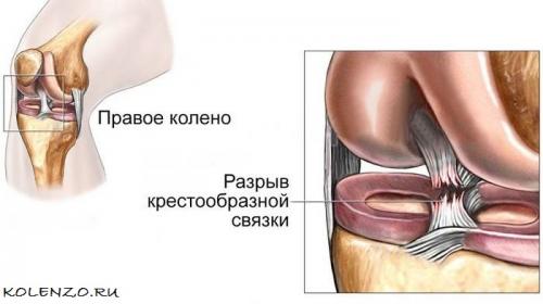 Передняя крестообразная связка разволокнена. Крестообразная связка коленного сустава: анатомия, травмы, лечение