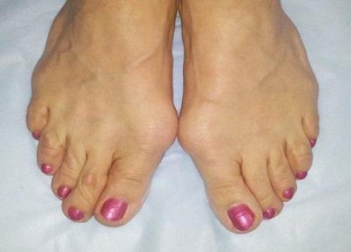 Шишки на ногах лечение народными средствами. Как избавиться от косточки на ногах народными средствами