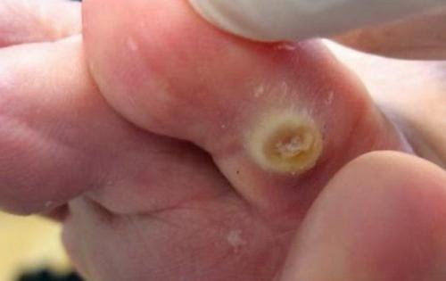 Шишка на пальце ноги похожая на мозоль. Разновидности мозолей