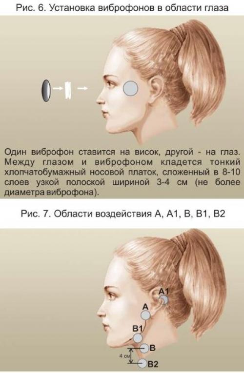 Фонирование википедия. Области воздействия и места установки виброфонов