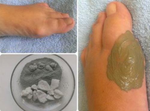 Шишки на ногах лечение народными средствами. Как избавиться от косточки на ногах народными средствами