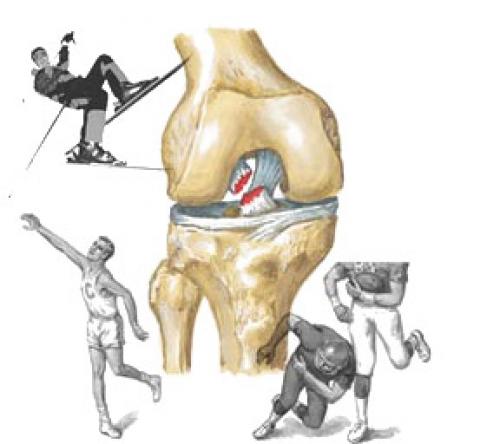 Разрыв пкс коленного сустава лечение. Причины повреждений крестовидных связок 06