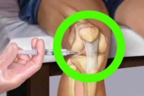 Препараты для лечения суставов: виды, список