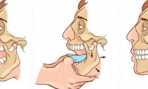 Может ли вывих челюсти пройти сам. Вывих челюсти: симптомы и лечение