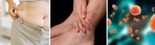 Код по мкб артрит голеностопного сустава. Артрозо-артрит голеностопного сустава: код мкб-10, симптомы и лечение