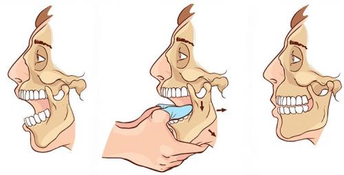 Подвывих челюсти, как вправить самостоятельно. Исправляем вывих челюсти –, как вправить челюсть самостоятельно