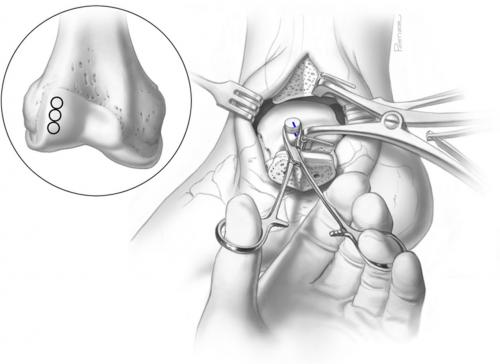 Некроз таранной кости это. АСЕПТИЧЕСКИЙ НЕКРОЗ ТАРАННОЙ КОСТИ