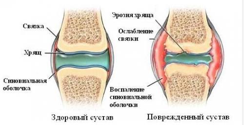 Лучшие хондропротекторы для коленного сустава. Препараты-хондропротекторы для суставов