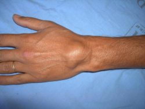 Гигрома операция. Хирургическое лечение гигромы