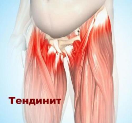 Тазобедренный сустав фото где находится у женщин симптомы